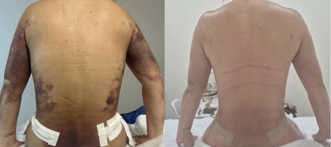 Post-Surgical Recovery