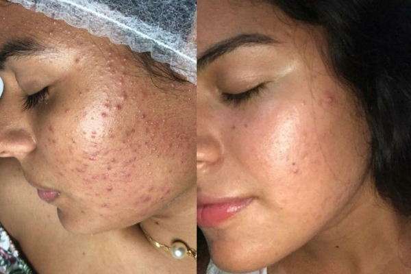 Advanced Facial Treatments